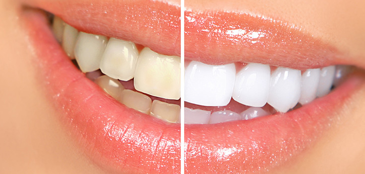 Best Home Remedies To Get White Shiny Teeth